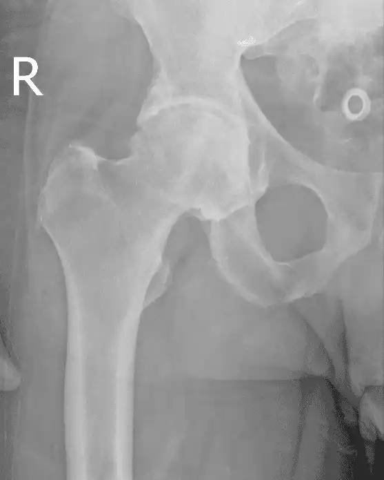 Hip bone density scan image